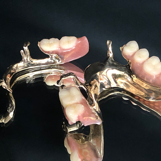 顎関節症を長年患われた方の最終完成義歯